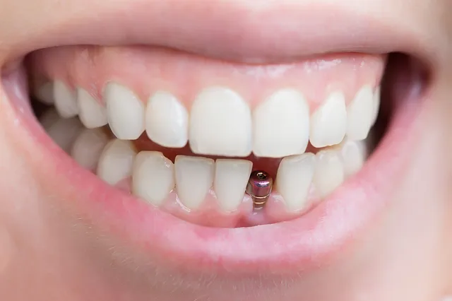 dental implants in Toronto