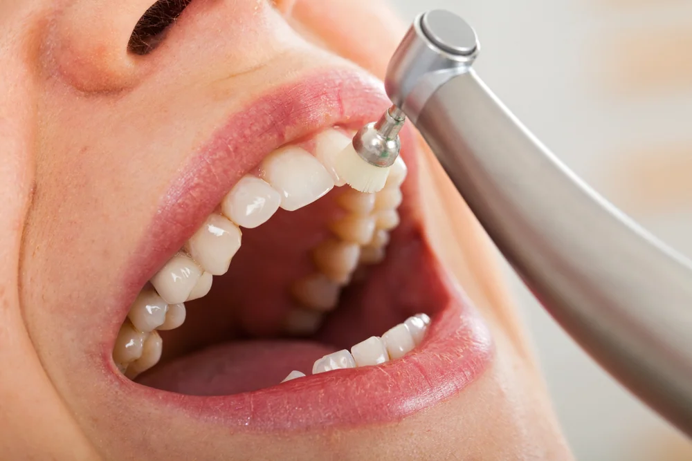 fluoride treatments for adults